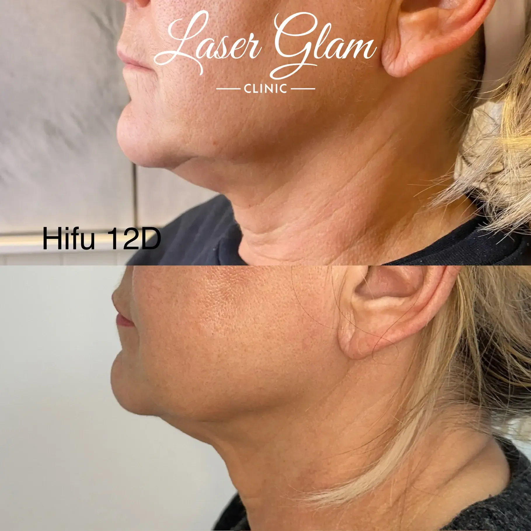 Före och efter HIFU 12D, profil mot hals och käke