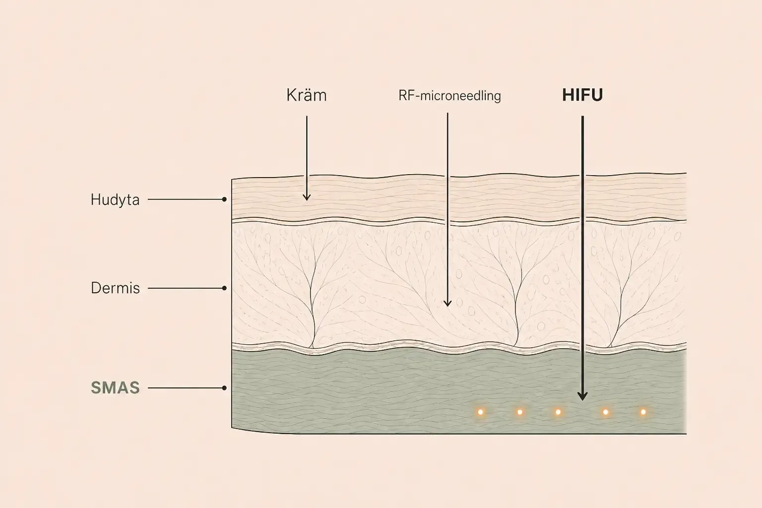 Hur djupt kräm, RF-microneedling och HIFU når: bara HIFU kommer ner till SMAS-lagret